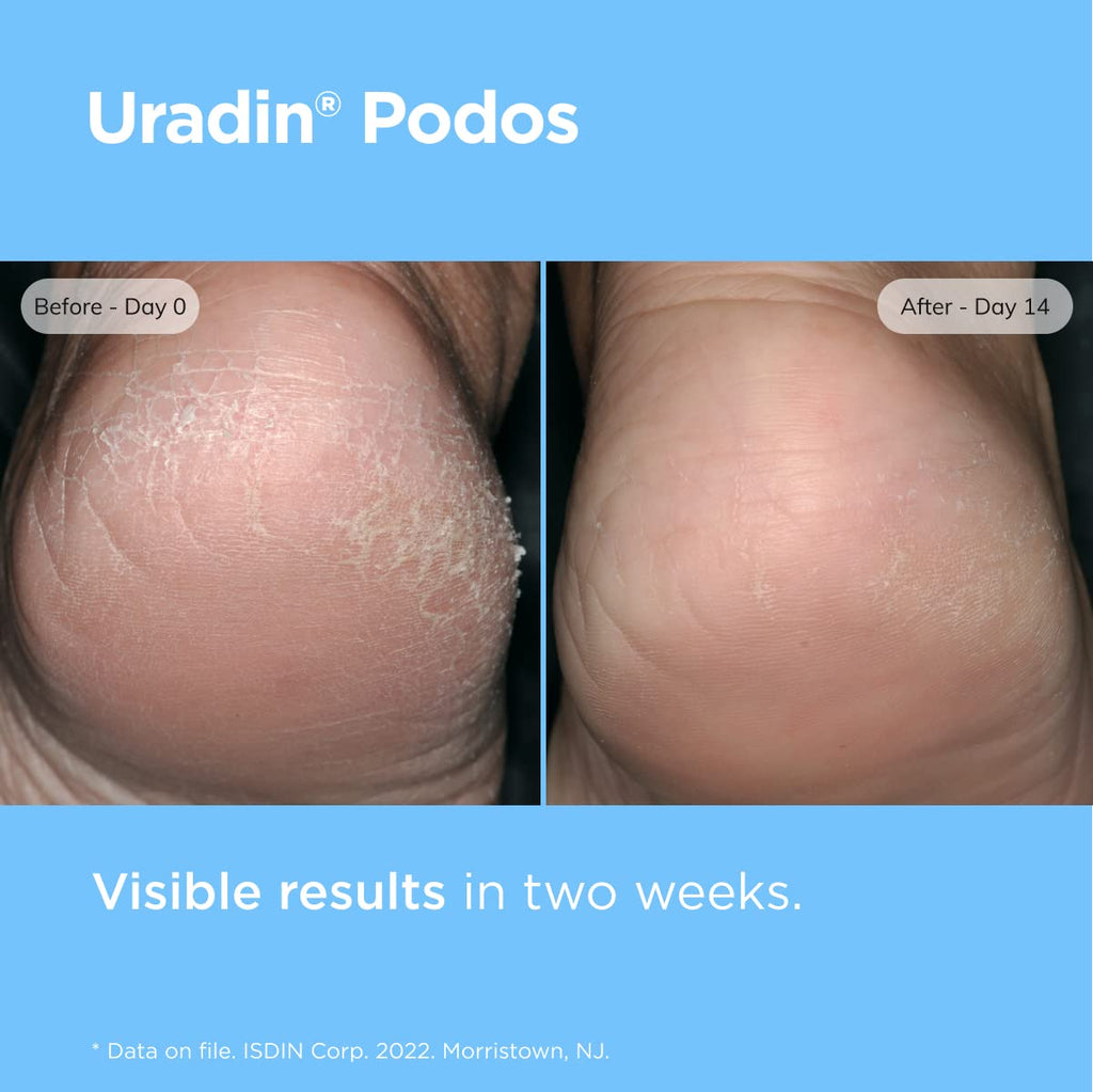 ISDIN Uradin Podos Foot Cream, 10% Urea for Dry, Cracked Feet