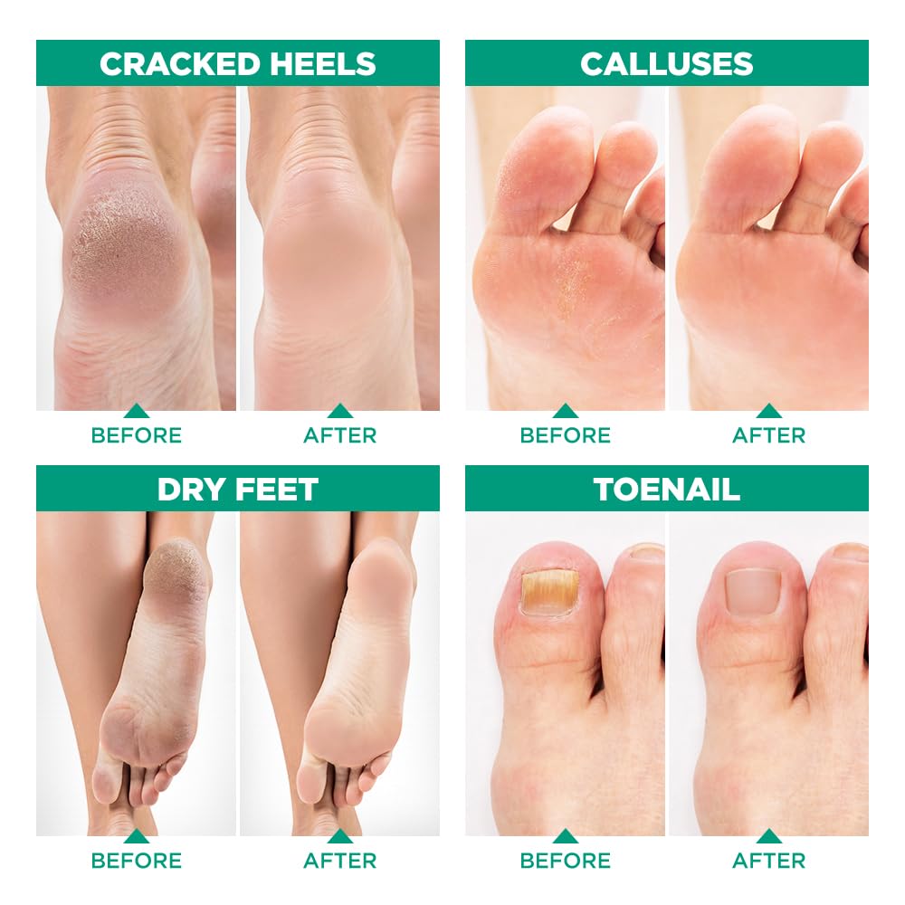 Tea Tree Oil Foot Soak with Epsom Salt