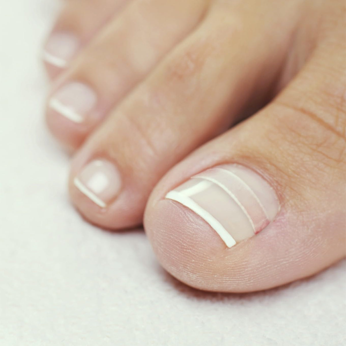 CurveCorrect Ingrown Toenail Treatment Kit with Clear Nail Braces
