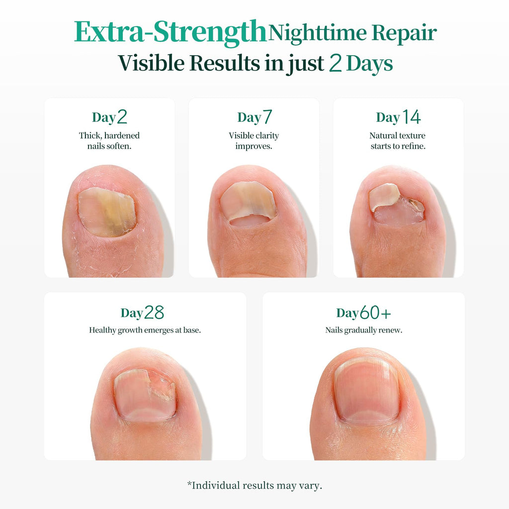 APUREE 1% Tolnaftate Fungal Nail Patches, 8-Hour Overnight Treatment