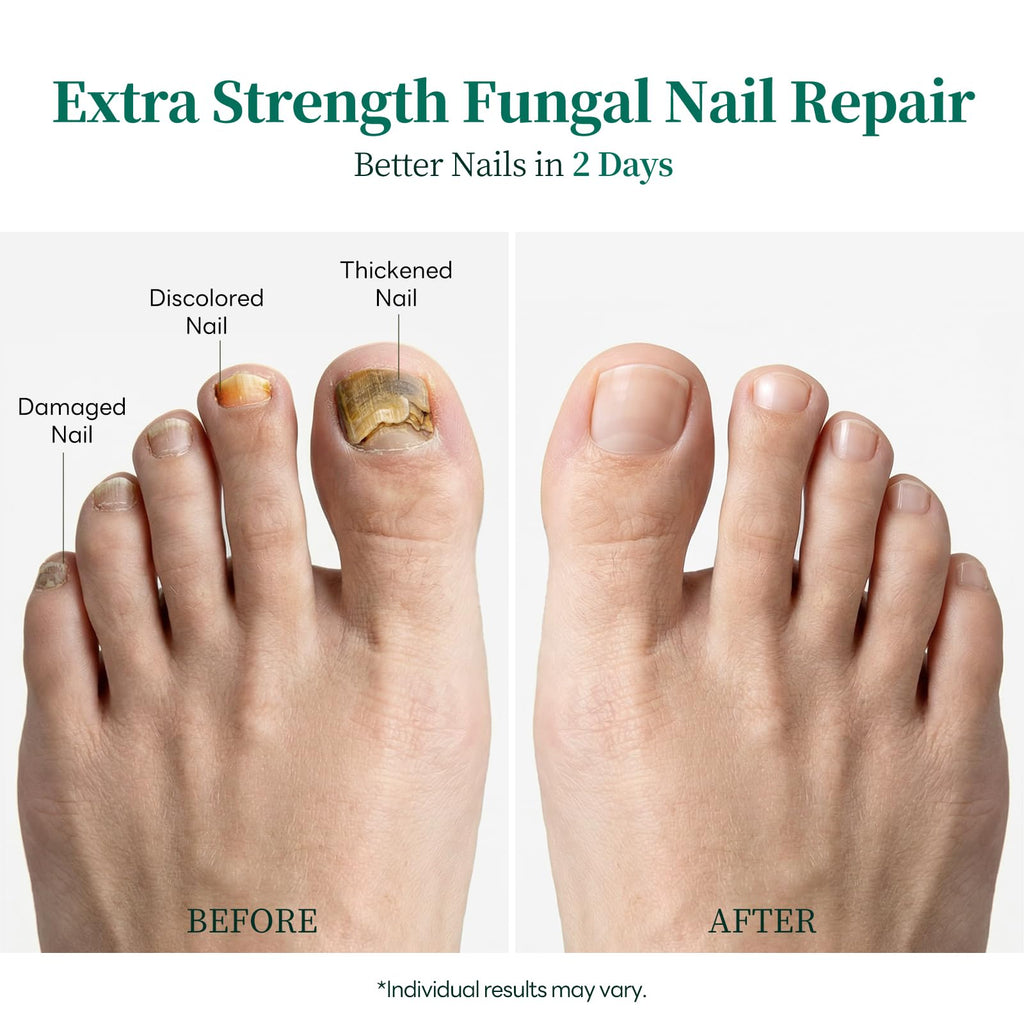 Apuree Antifungal Nail Pen with 1% Tolnaftate and Tea Tree Oil
