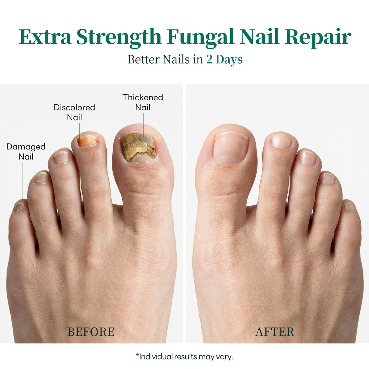 Apuree Antifungal Nail Pen with 1% Tolnaftate and Tea Tree Oil