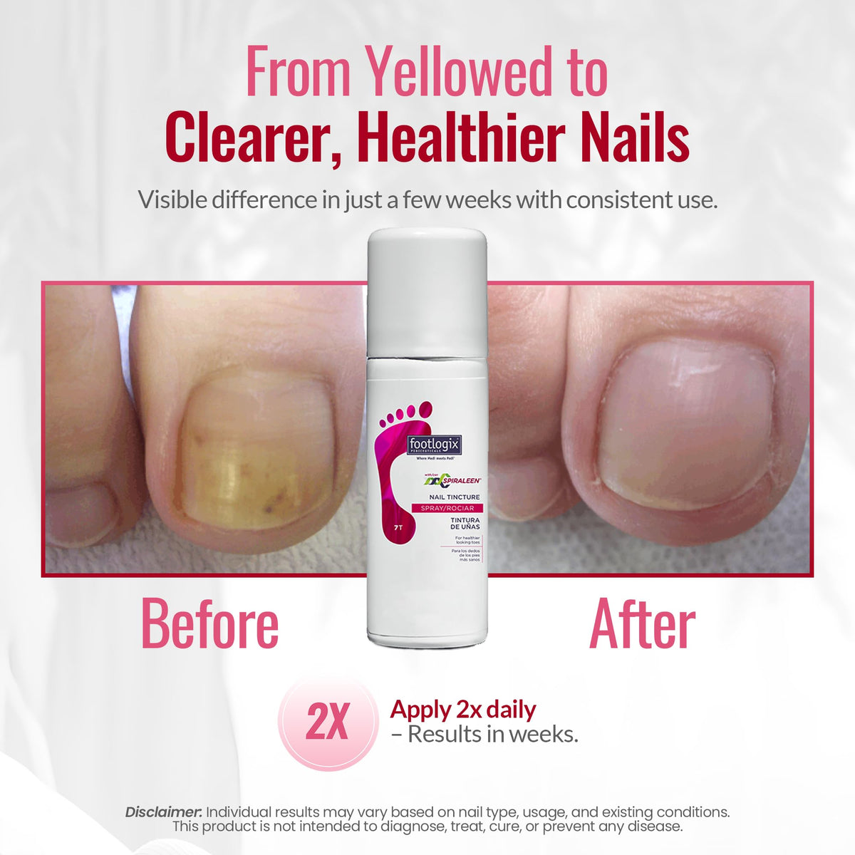 Footlogix Nail Tincture Spray with Spiraleen, Tea Tree Oil & Panthenol