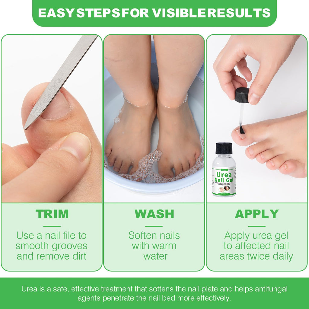50% Urea Nail Gel for Thick Nails, Calluses and Rough Skin