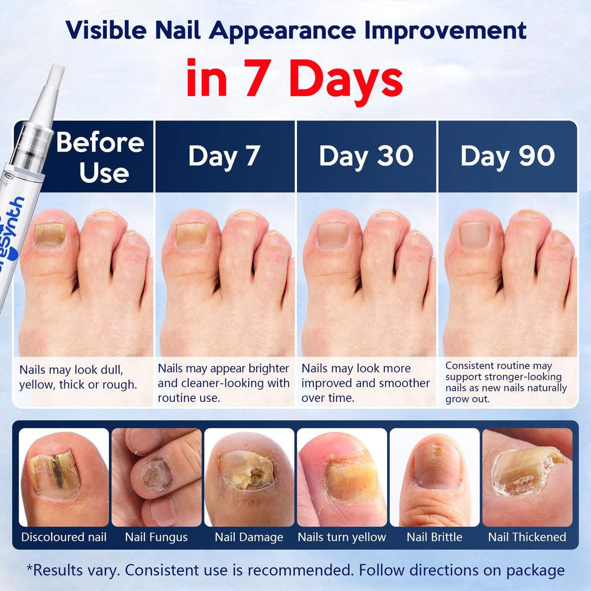 Nail Fungus Repair Pen with 25% Undecylenic Acid, Aloe & Vitamin E