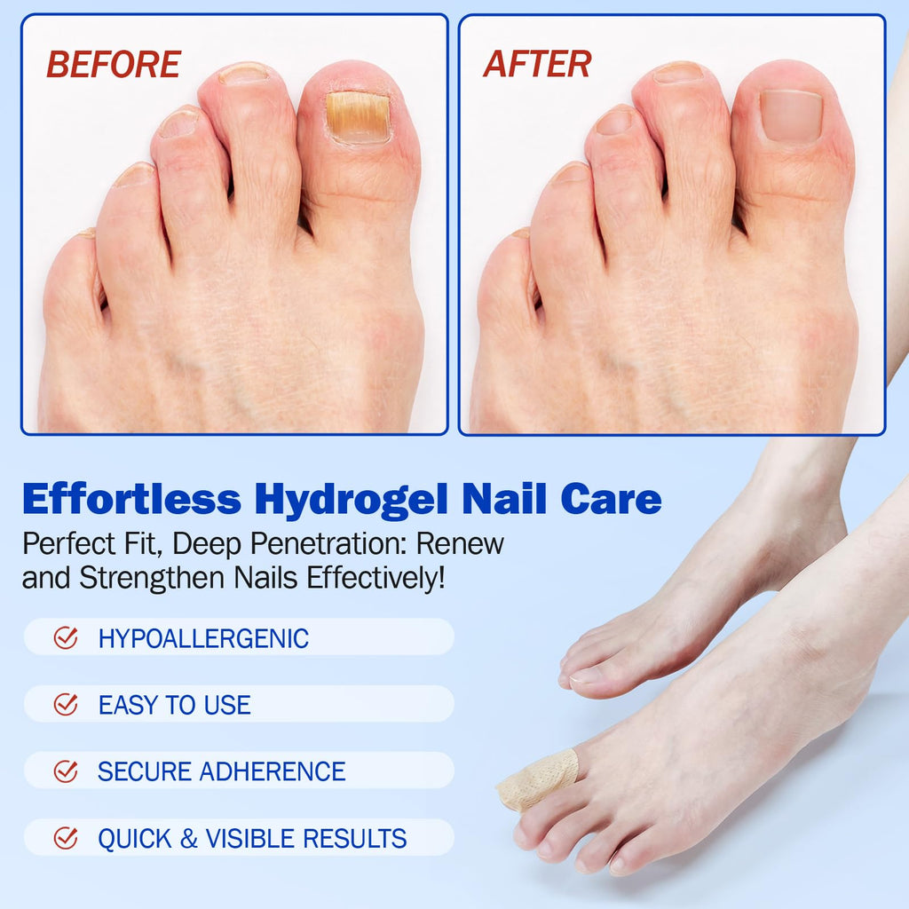 Toenail Repair Patches – Overnight Nail Care