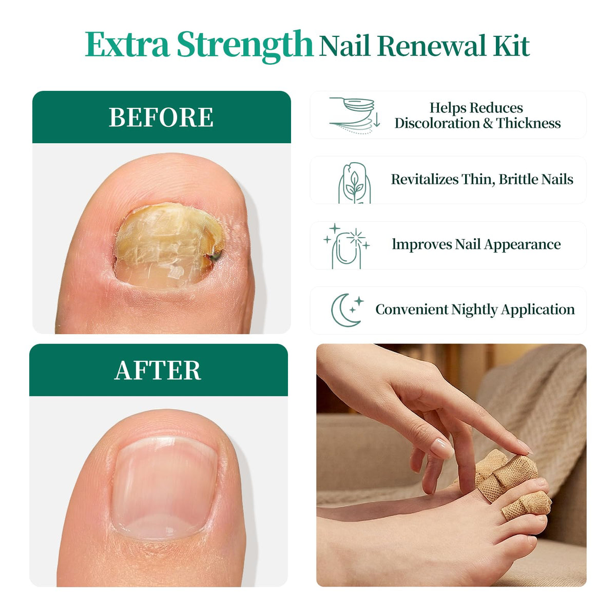 APUREE 1% Tolnaftate Fungal Nail Patches, 8-Hour Overnight Treatment