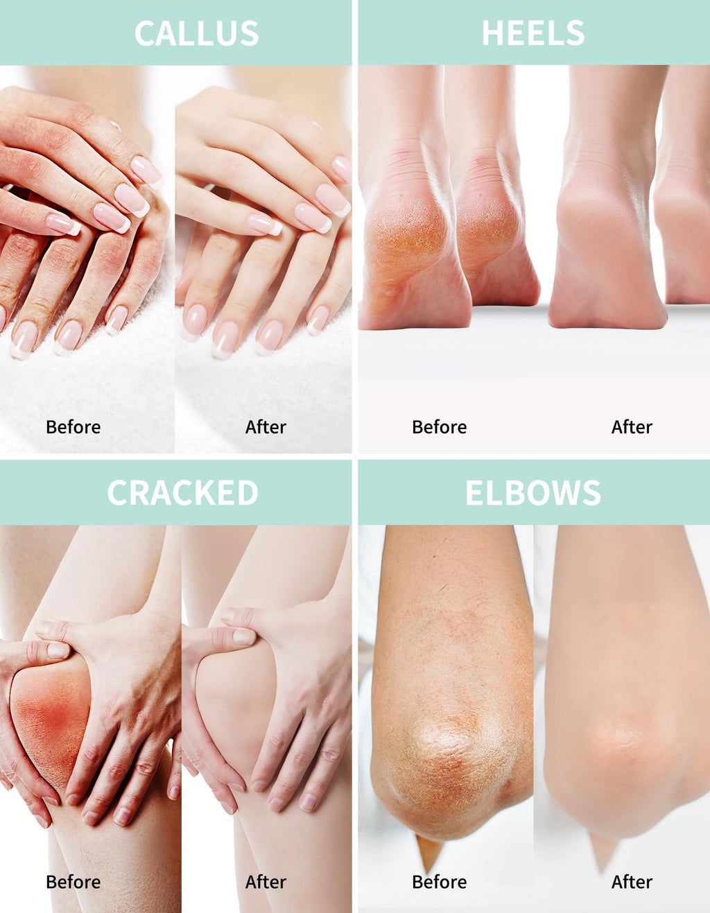Grocerism Urea Cream with 2% Salicylic Acid for Rough, Dry Skin