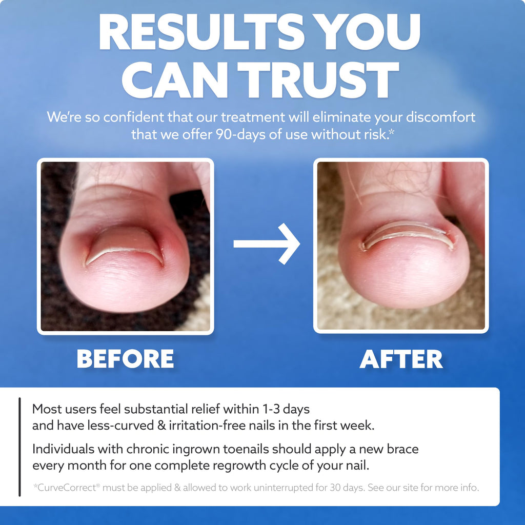 CurveCorrect Ingrown Toenail Treatment Kit with Clear Nail Braces