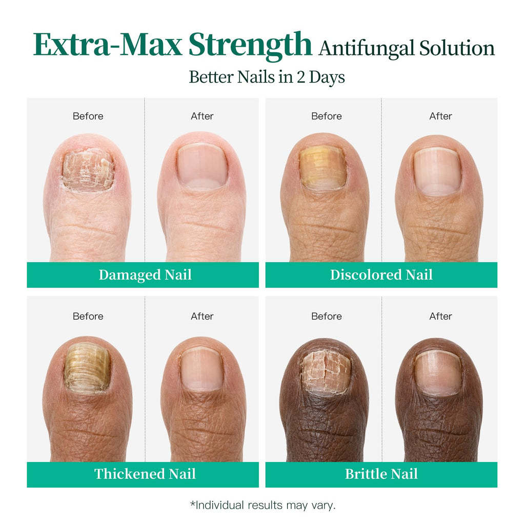 Apuree Extra Strength Toenail Fungus Treatment, 25% Undecylenic Acid + 1% Tolnaftate