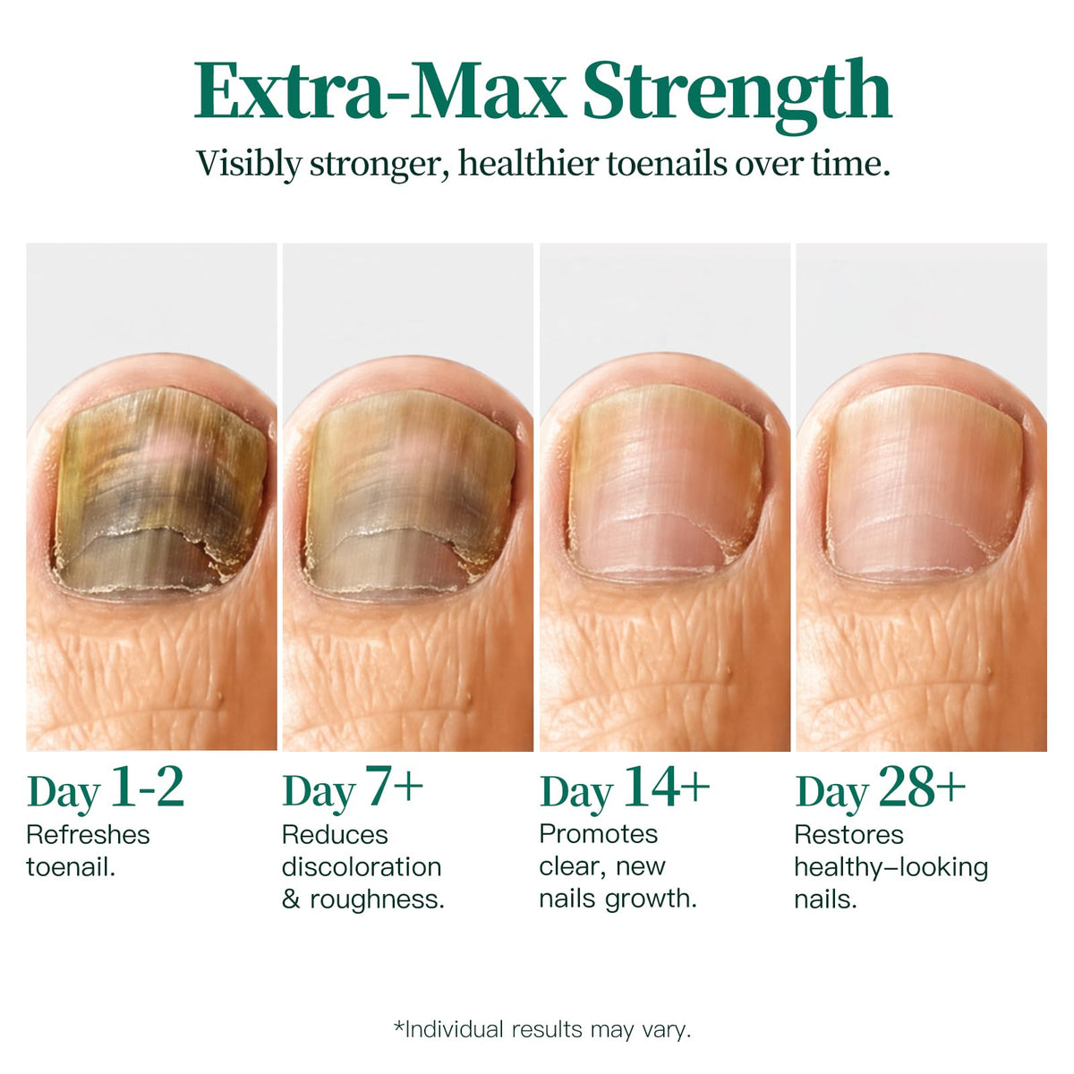 Apuree Extra Strength Toenail Fungus Treatment, 25% Undecylenic Acid + 1% Tolnaftate