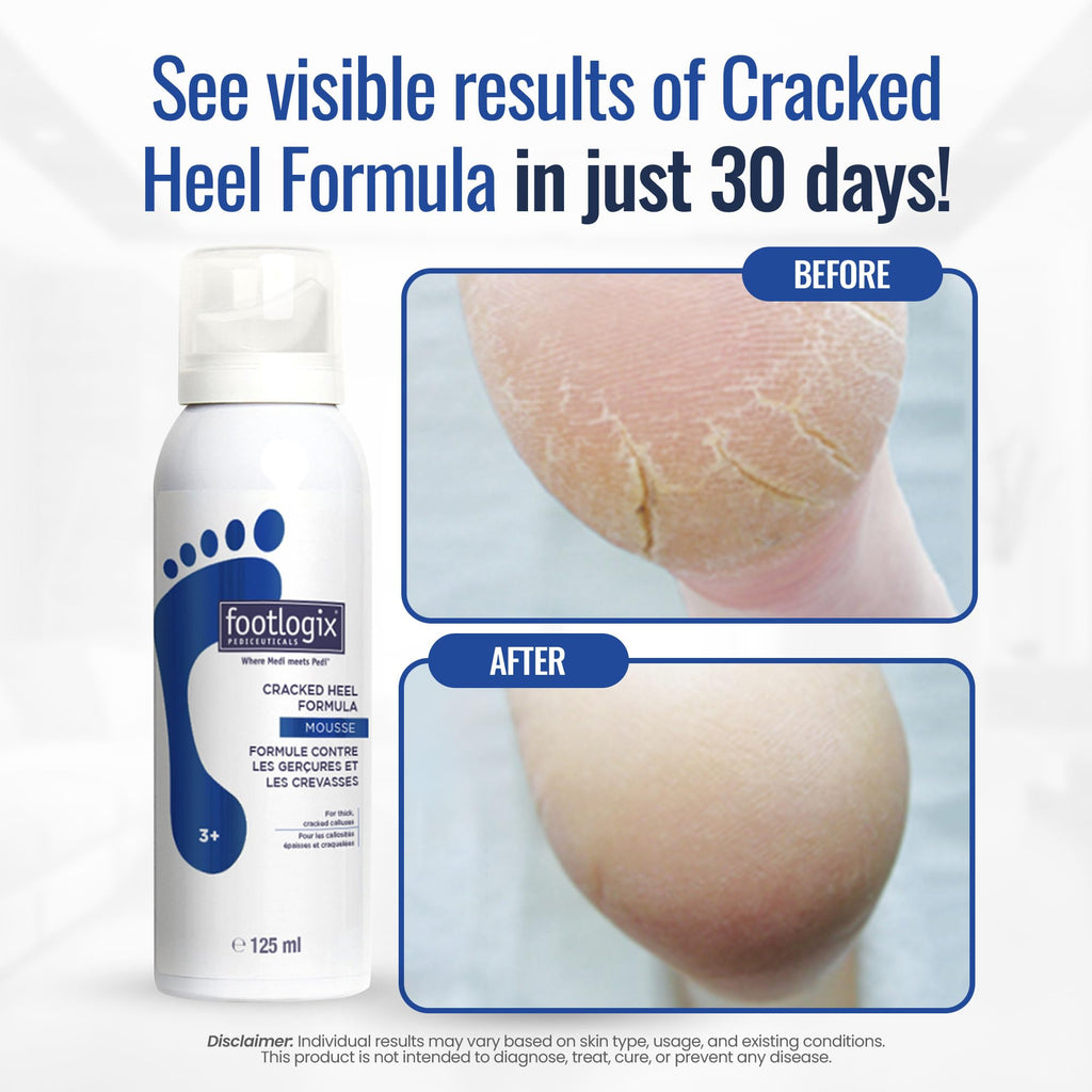 FOOTLOGIX Cracked Heel Formula Mousse with Urea, 4.23 oz