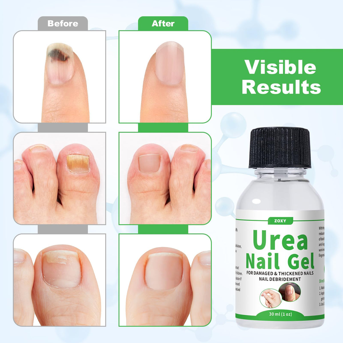 50% Urea Nail Gel for Thick Nails, Calluses and Rough Skin