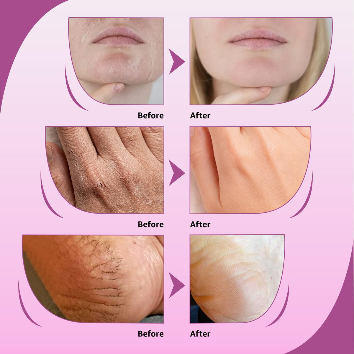 10% Urea Cream with Aloe Vera, Jojoba Oil & Salicylic Acid, 150ml