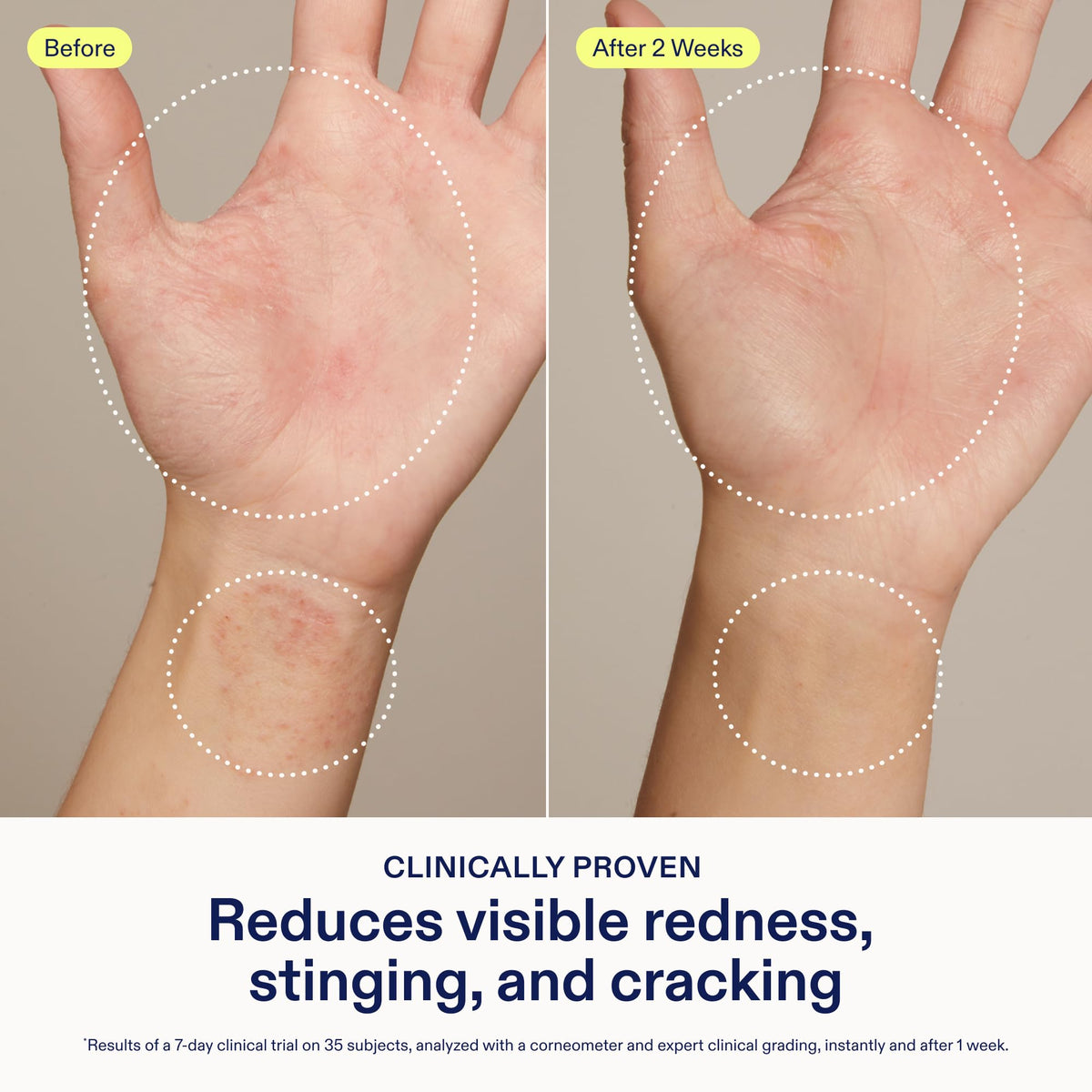 Skinfix Hand Relief Cream for Dry, Sensitive Skin, Fragrance-Free