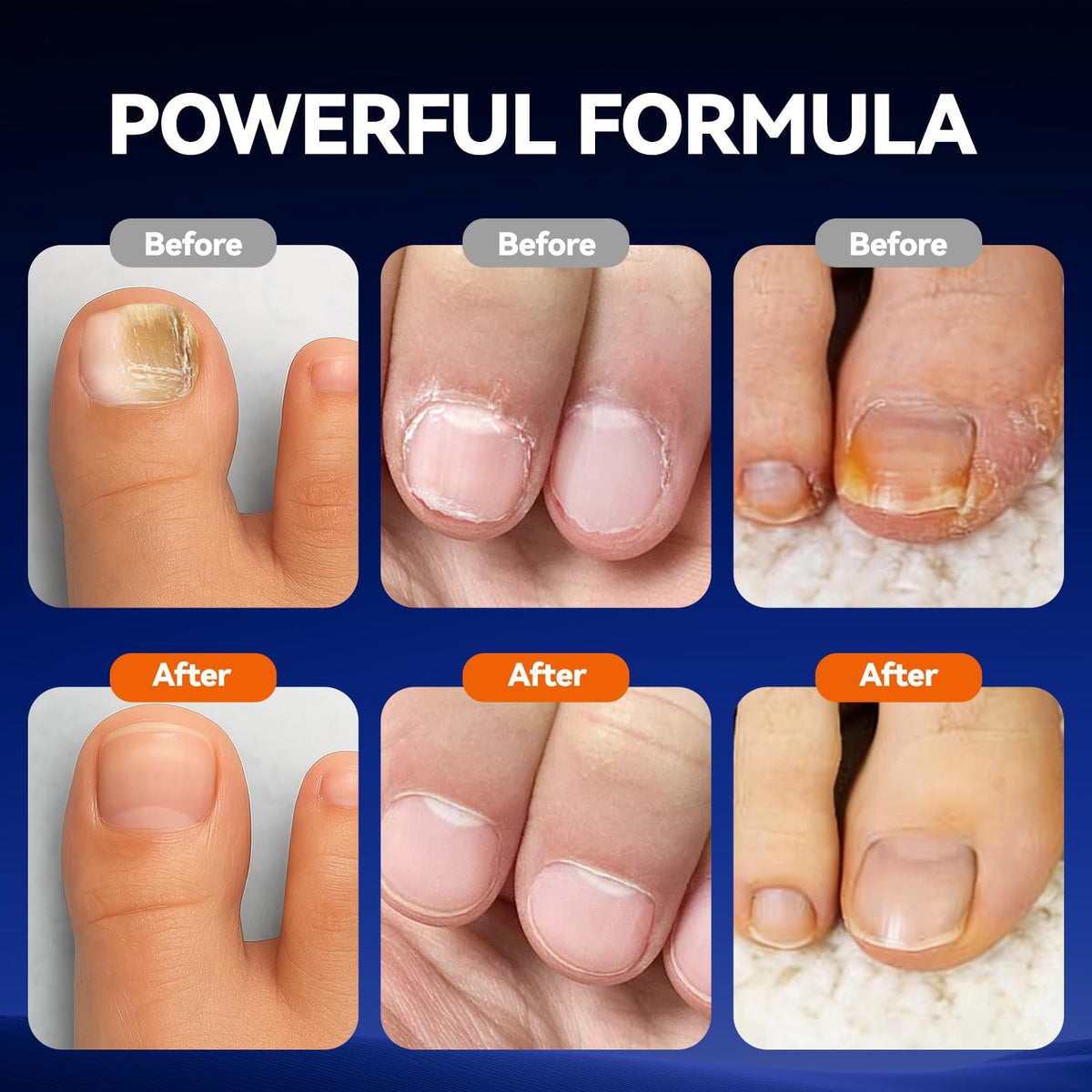 Toenail Fungus Pen with 25% Undecylenic Acid, 5 Pens and Nail File