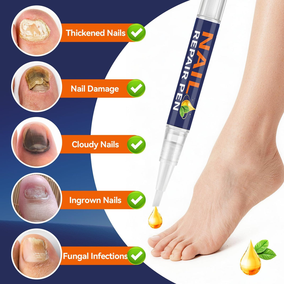 Toenail Fungus Pen with 25% Undecylenic Acid, 5 Pens and Nail File