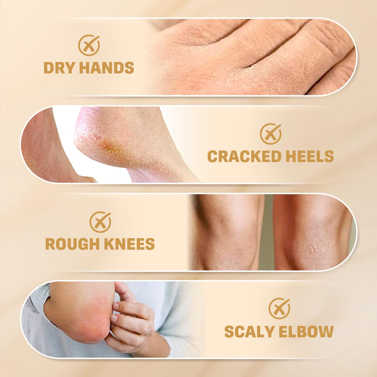 60% Urea Cream with 2% Salicylic Acid for Dry, Rough Skin