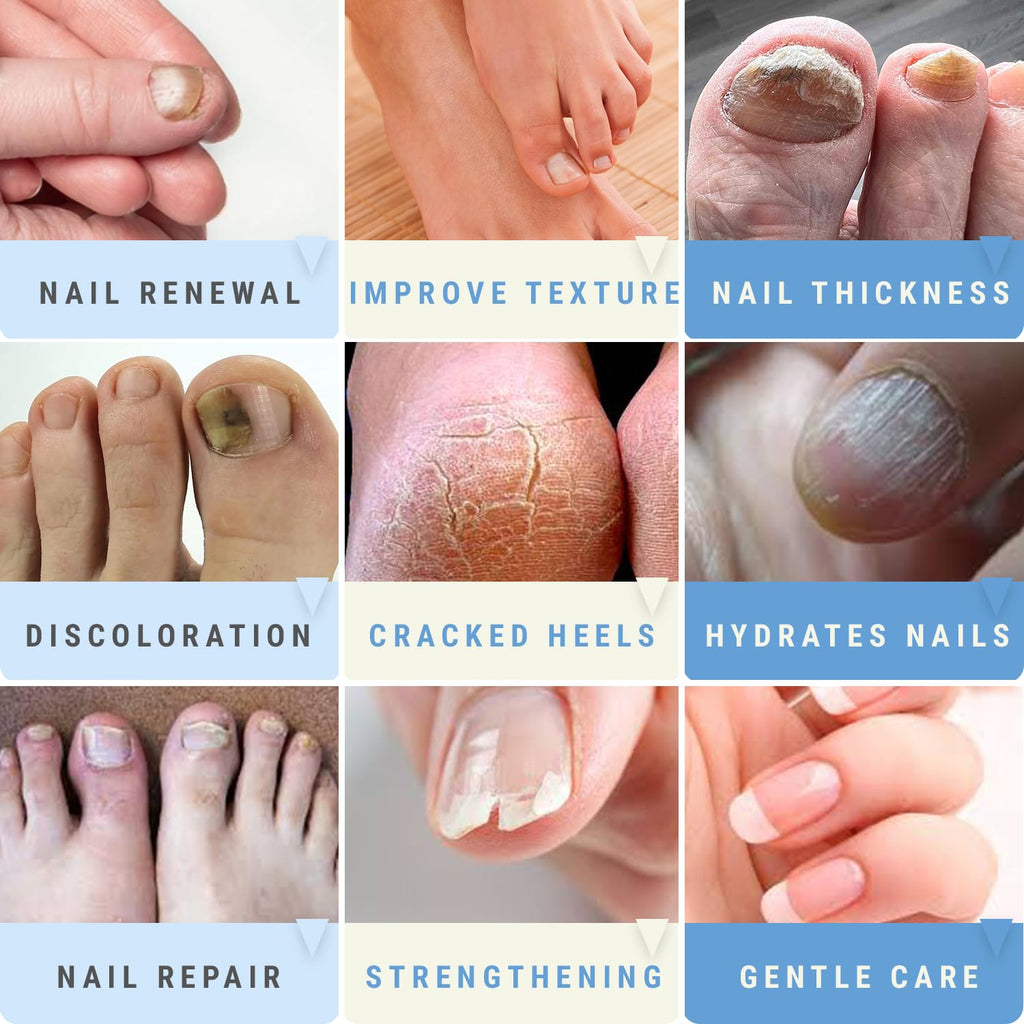Urea Nail Gel for Fingernail and Toenail Care