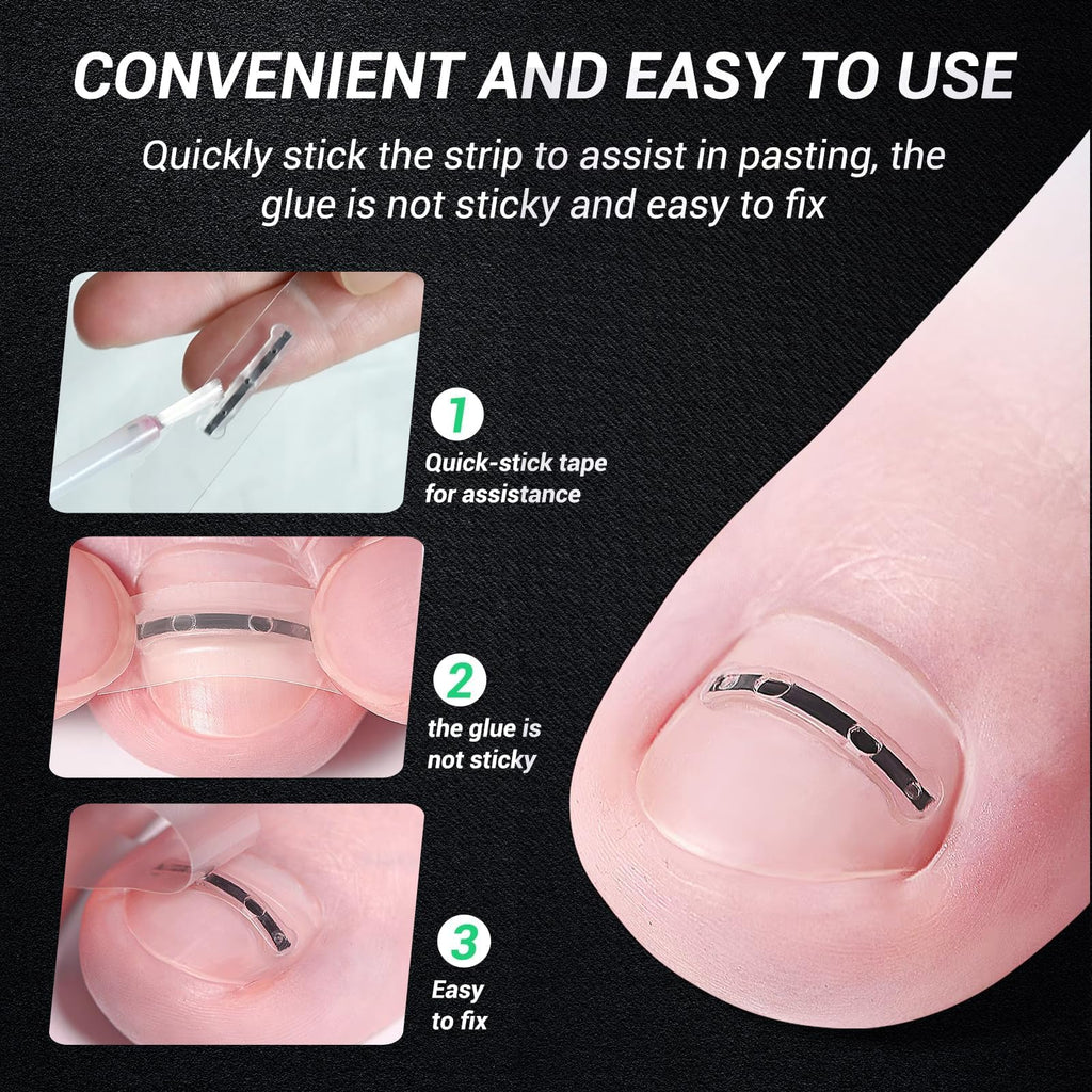 Reieset Titanium Alloy Ingrown Toenail Correction Patch