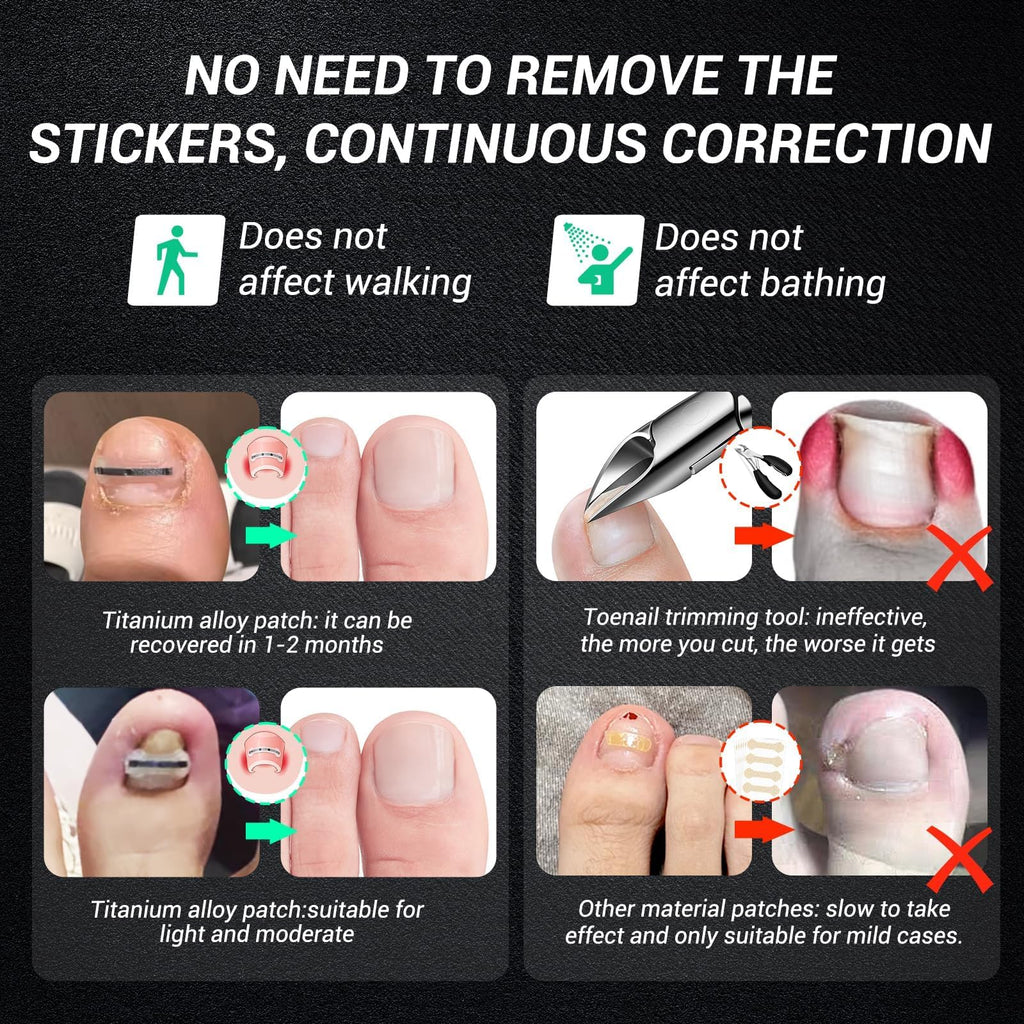 Reieset Titanium Alloy Ingrown Toenail Correction Patch
