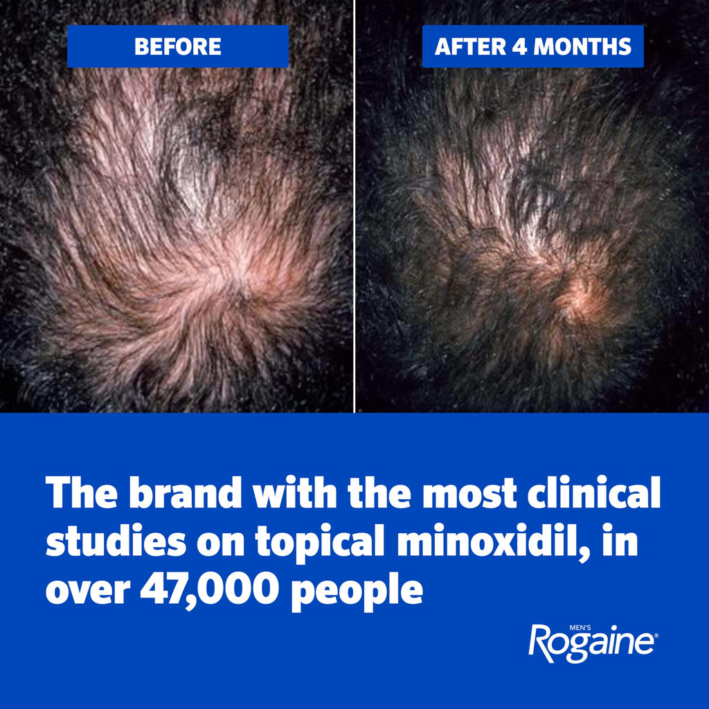 Rogaine Men's 5% Minoxidil Unscented Topical Hair Regrowth Foam