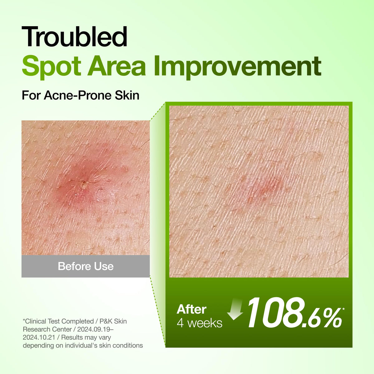 Anua Azelaic Acid 10 Hyaluron Redness Soothing Facial Serum
