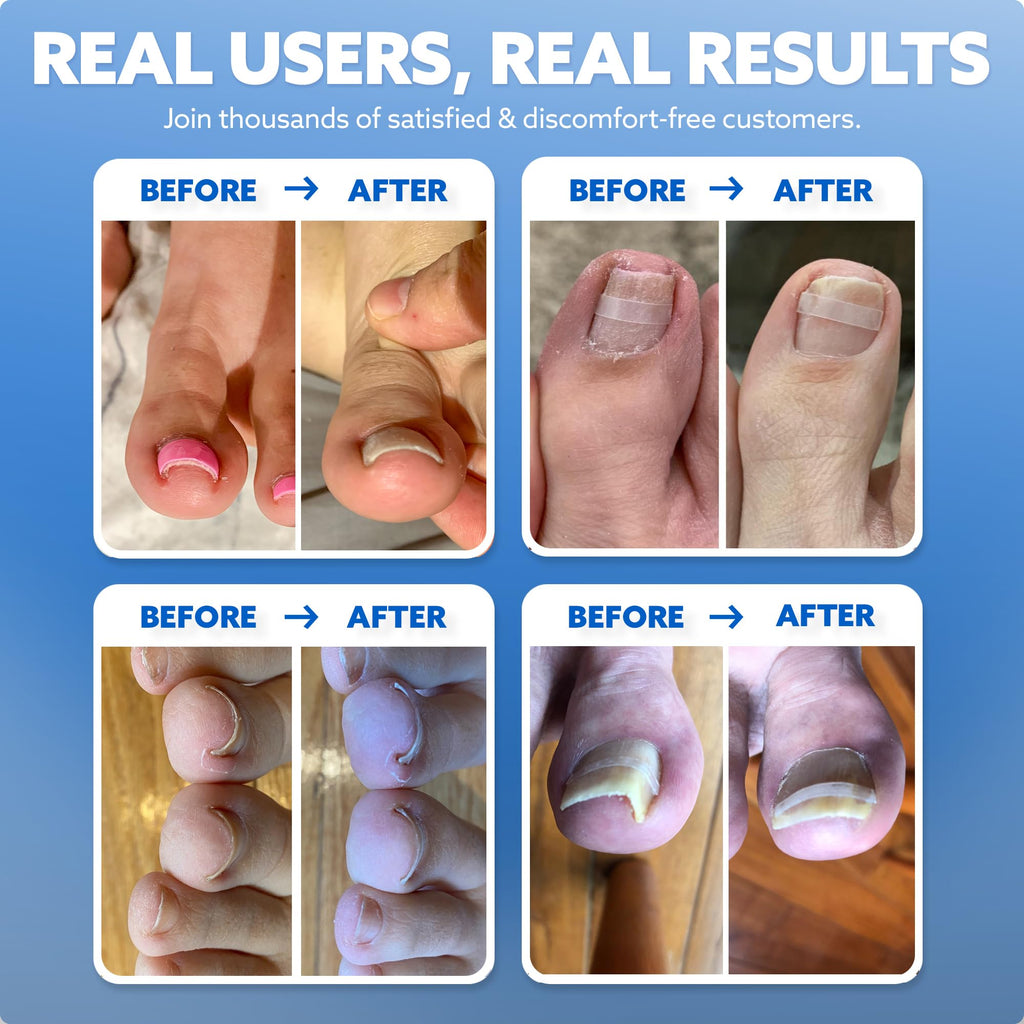 CurveCorrect Ingrown Toenail Treatment Kit with Clear Nail Braces