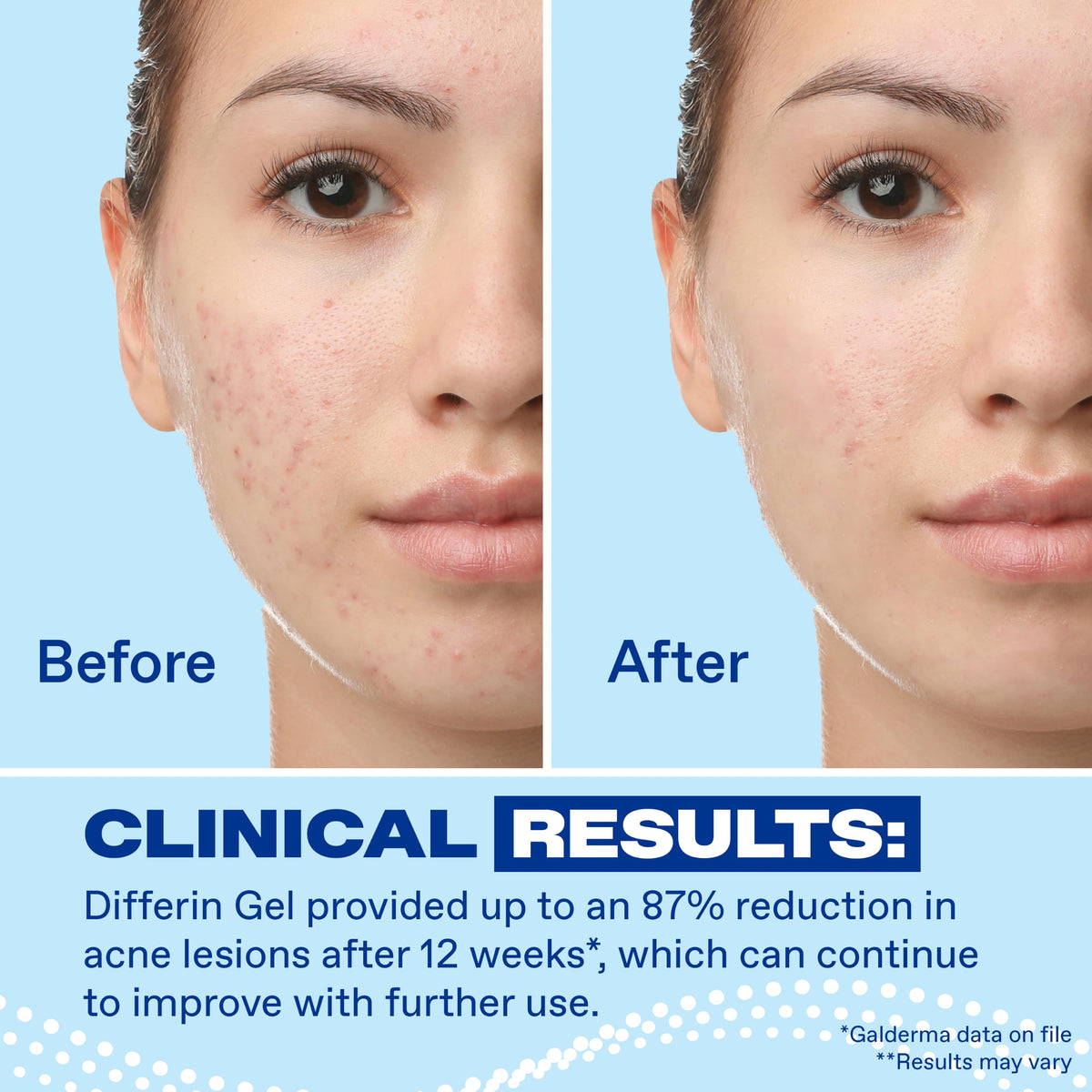 Differin Adapalene Acne Treatment Gel 0.1%, 45g Pump