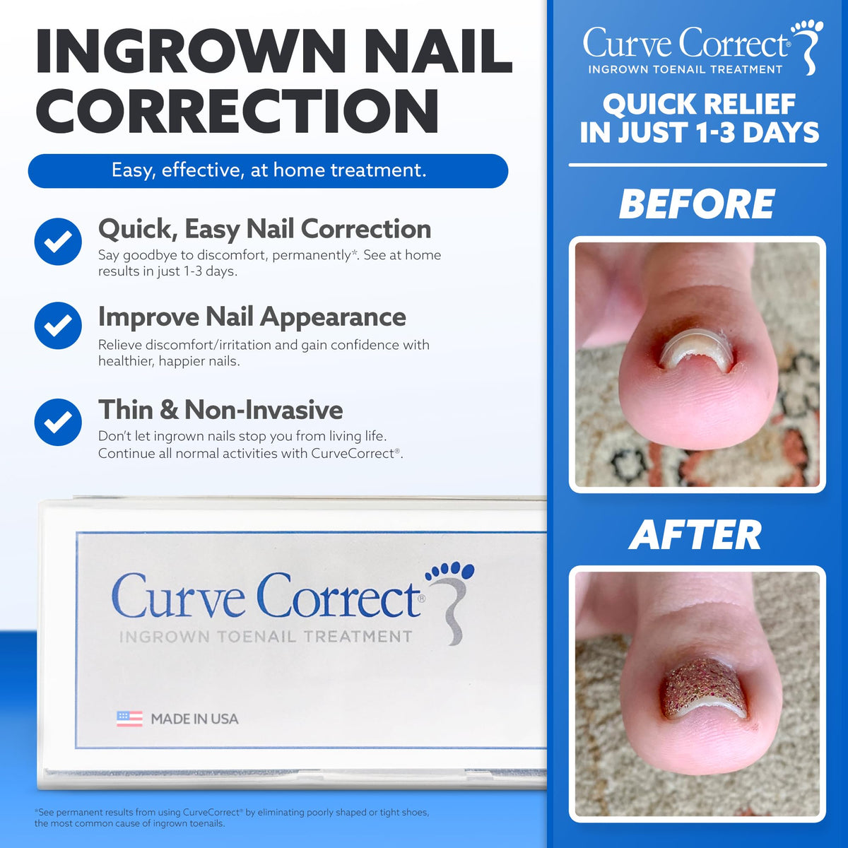 CurveCorrect Ingrown Toenail Treatment Kit with Clear Nail Braces