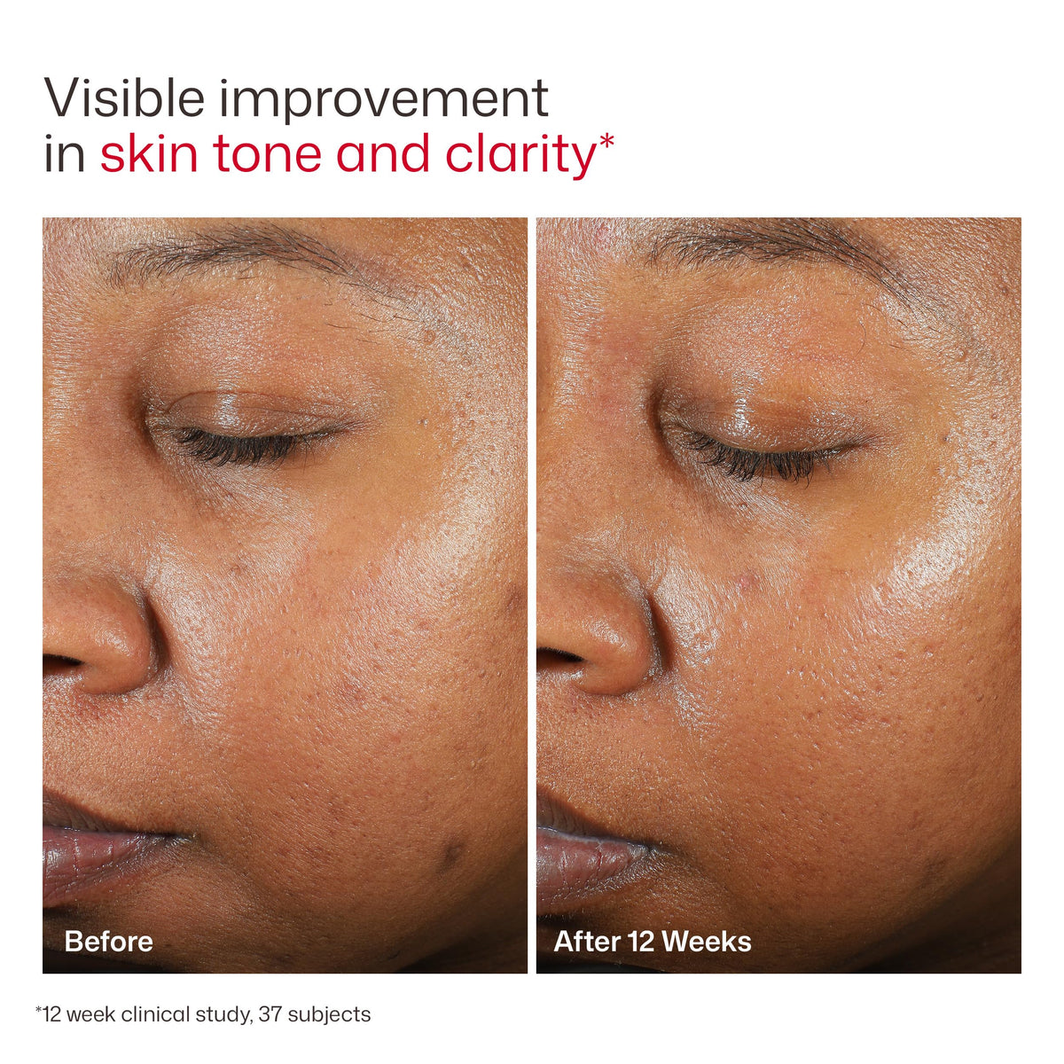 EltaMD UV Clear Face Sunscreen SPF 46, Oil-Free Broad Spectrum